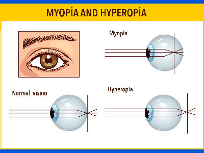 Eye chart explains myopia.