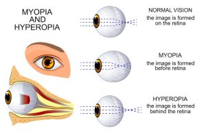 Eye: Myopia and Hyperopia Chart.